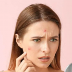 چگونه از پوست چرب و جوش دار مراقبت کنیم؟ | ارائه 3 راهکار موثر